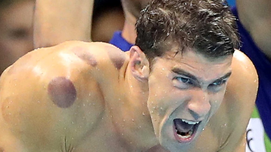 Micahel Phelps with cupping bruises at Rio Olympics