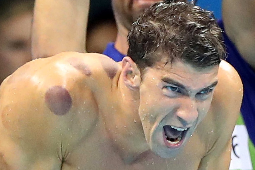 Micahel Phelps with cupping bruises at Rio Olympics