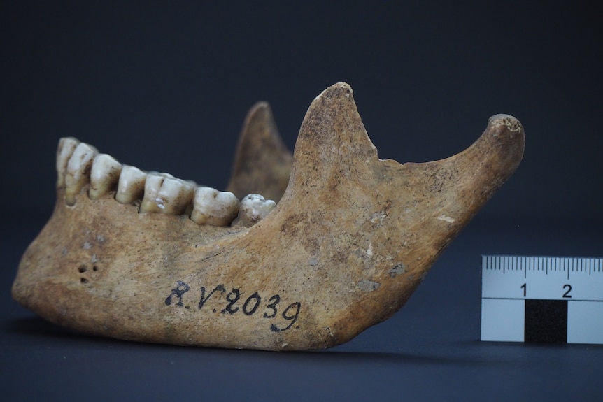 Jaw bone of 5,000 year old man 