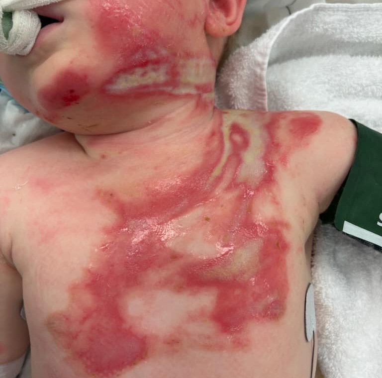 Burns on the body of a baby.