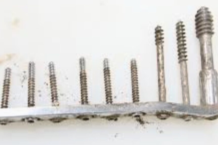 Photo of a surgical plate with screws that was removed from 