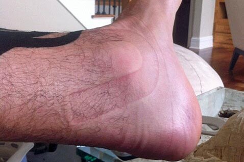Andrew Bogut displays his very swollen fractured ankle.