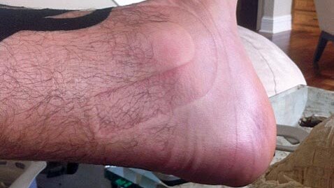 Bogut took a Twitter picture of his ankle after injuring it in January.
