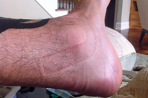 Bogut took a Twitter picture of his ankle after injuring it in January.