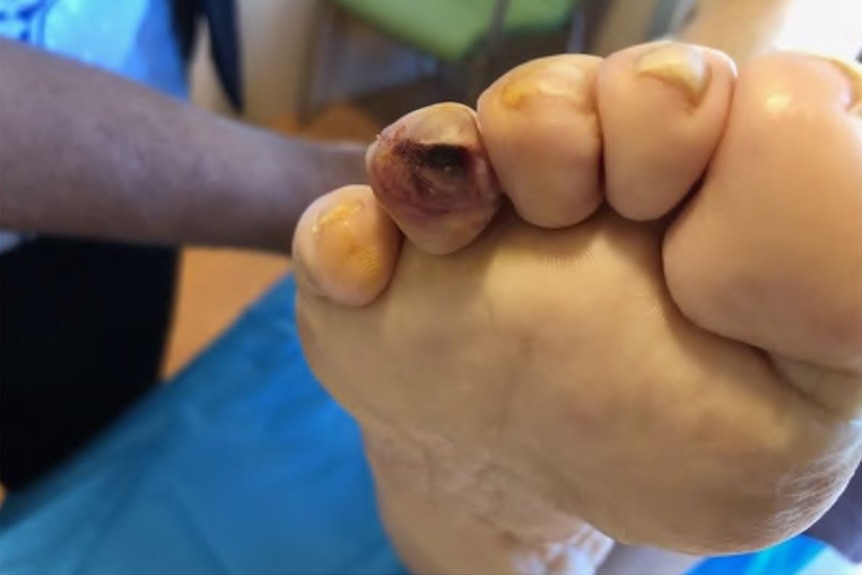 A blackened toe