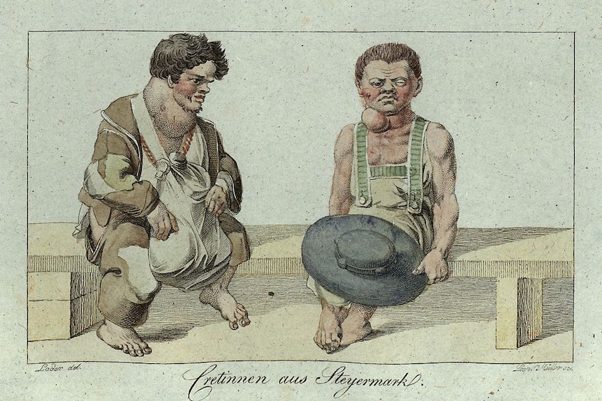 Leopold Müller's copper engraving depiction of "goitre and cretinism", 1815.