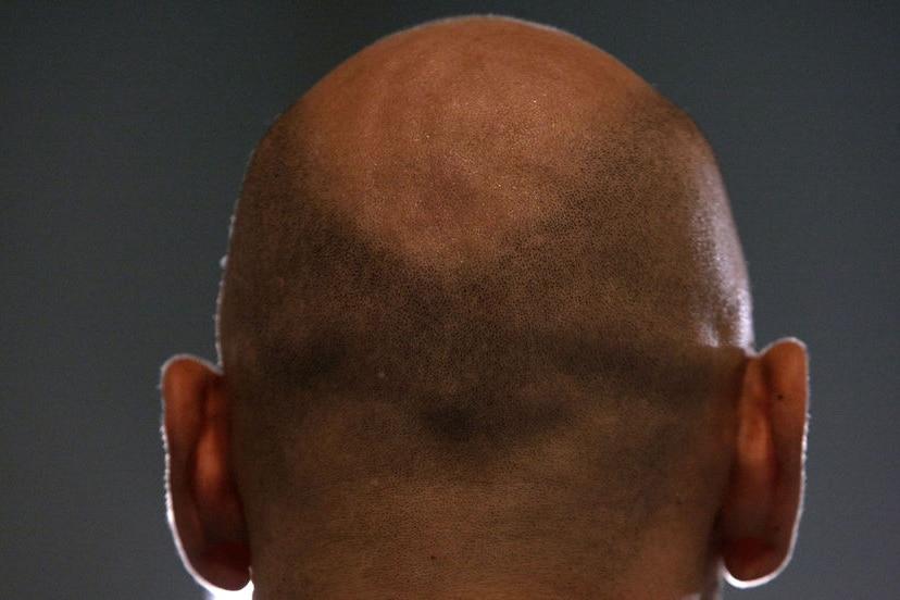 A balding man pictured from behind. His hair is shaved short.