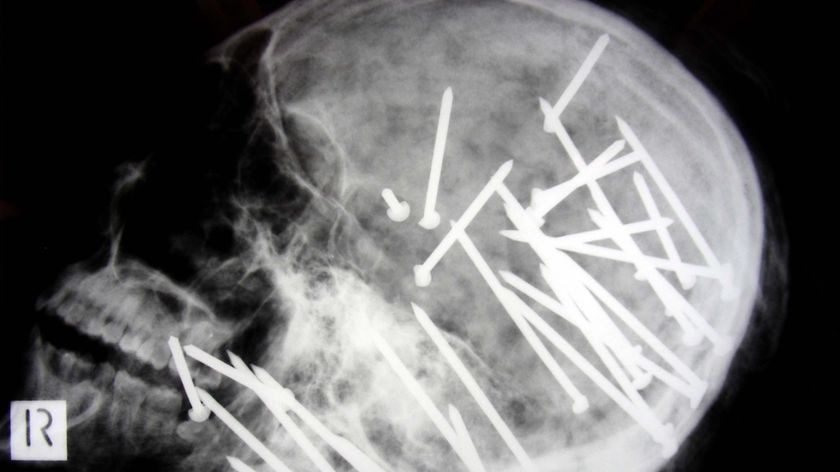 X-ray of the skull of 27-year-old Chen (Anthony) Liu