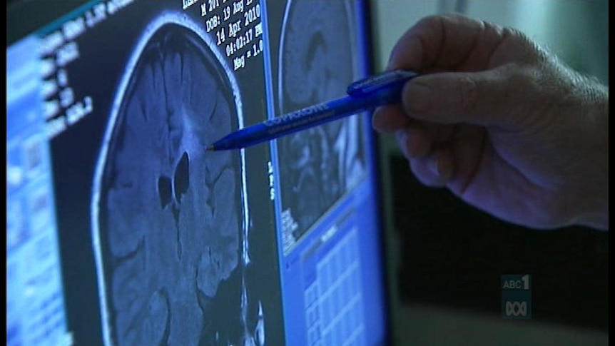 Researchers pinpoint migraine gene