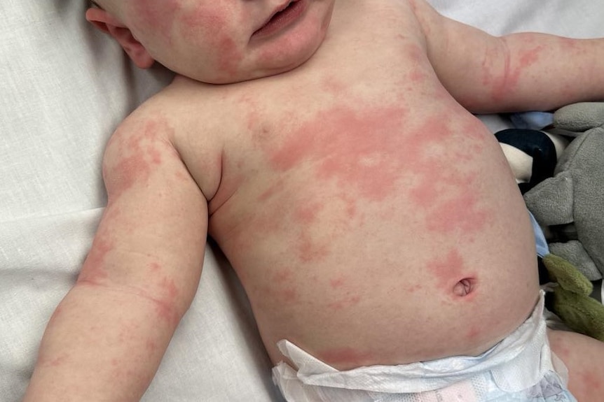 A baby covered in hives from an allergic reaction to food.