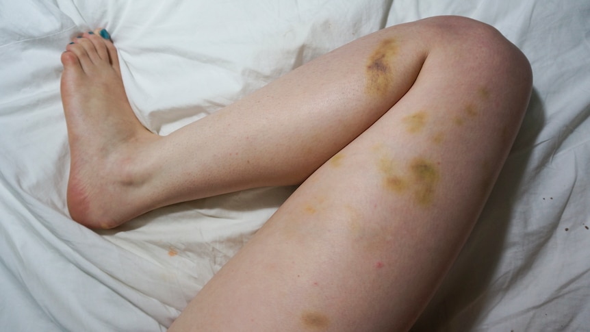A woman leg, on a white bed sheet, covered in greenish coloured bruises
