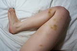 A woman leg, on a white bed sheet, covered in greenish coloured bruises