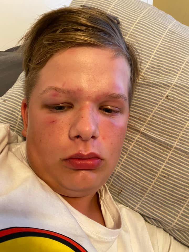 A boy with bruised face lying down.