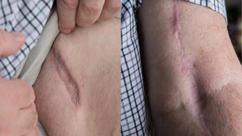 Brian Robert's at home showing an arm scar after suffering Compartment Syndrome from a motor bike accident .