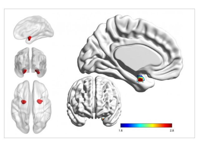 Five illustrations of the brain with parts lit up in red 