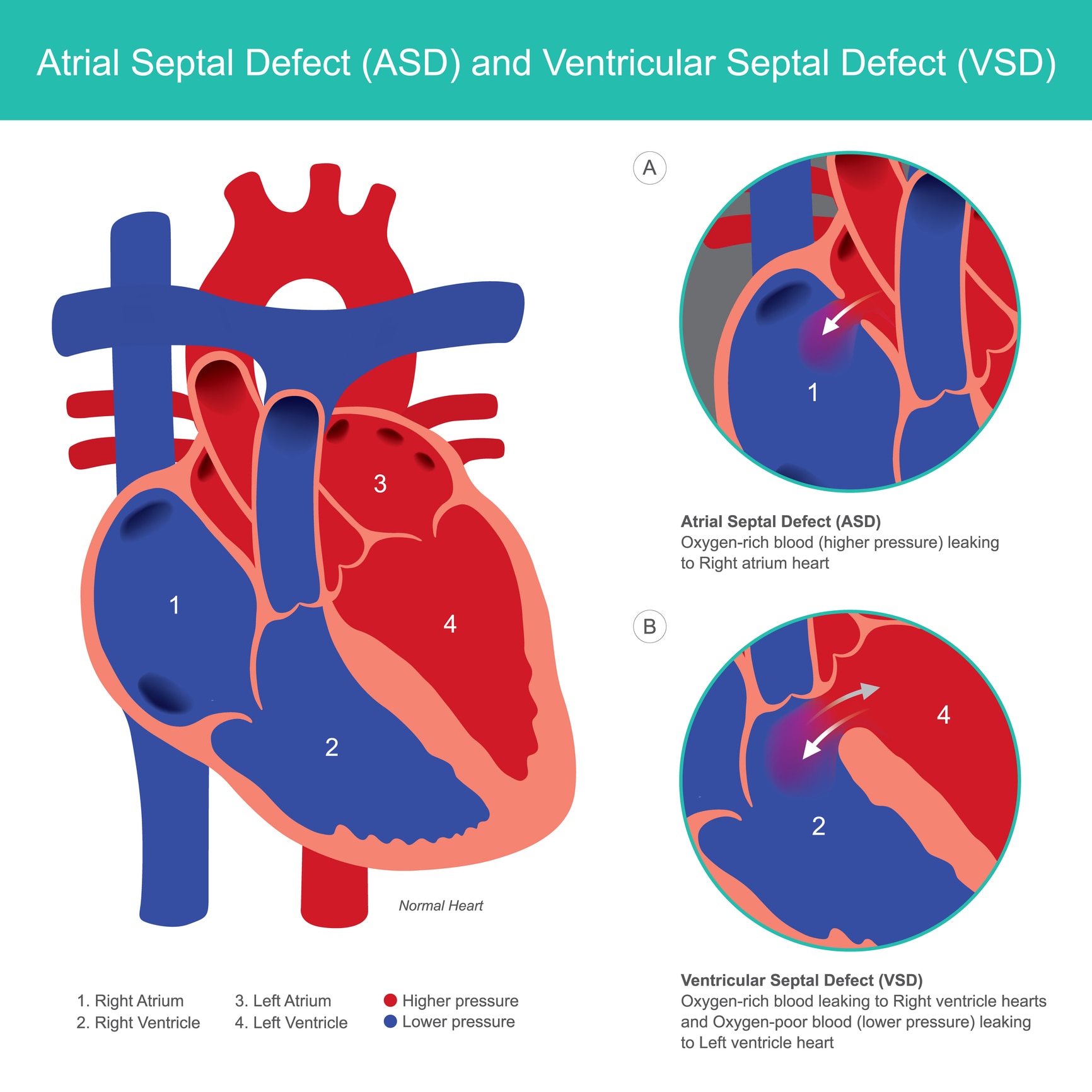 Three diagrams comparing a normal heart to a heart with an atrial septal defect and ventricular septal defect