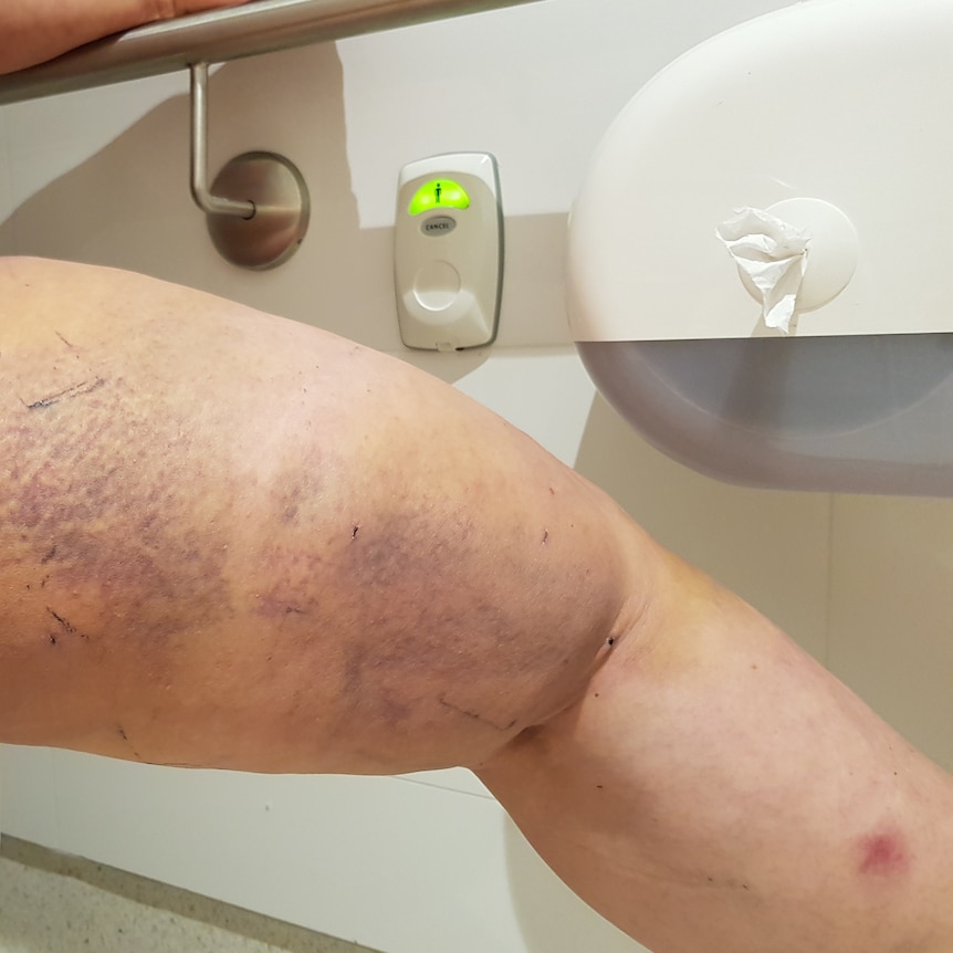 A leg with patches of purple discolouration along the thigh.