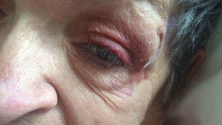 A close-up of an old woman with a black eye.