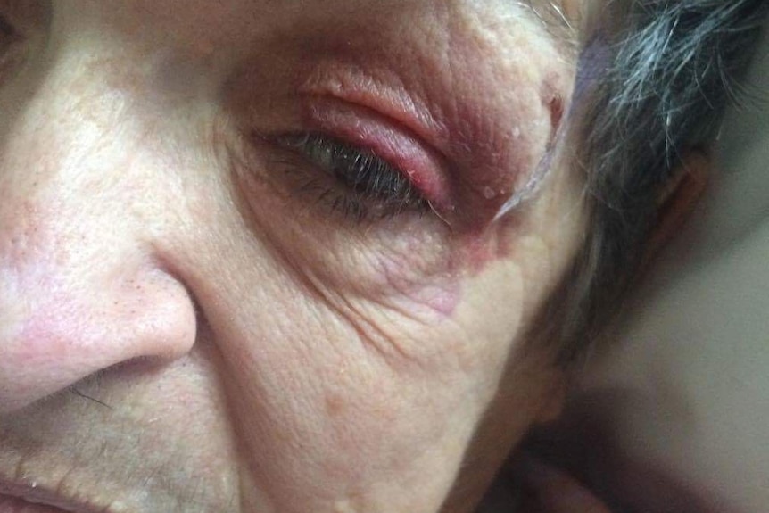 A close-up of an old woman with a black eye.