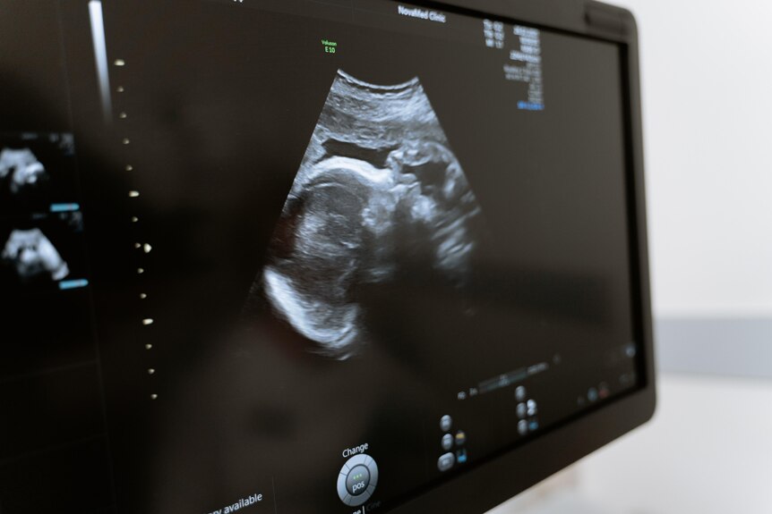 Ultrasound image of baby on monitor.