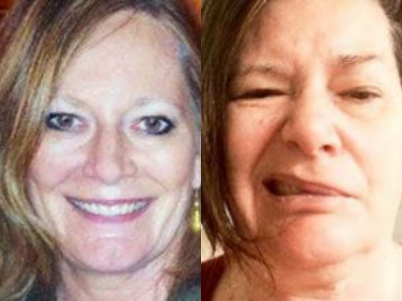Photos showing Elizabeth Robinson before and after her facial paralysis from Ramsay Hunt syndrome.