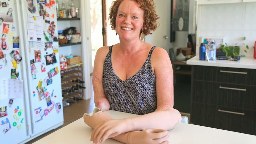 A woman poses, smiling, at her kitchen bench, with two prosthetic arms, detached, folded in front of her.
