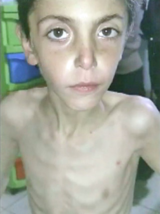 Starving boy in Madaya, Syria