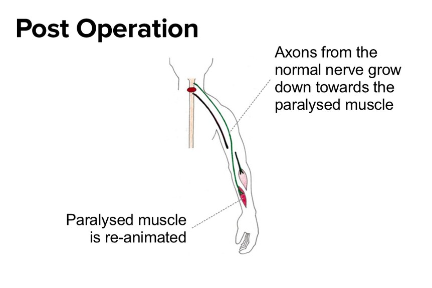 An illustration showing that post operation Axons from a healthy nerve will grow down towards a paralysed muscle.