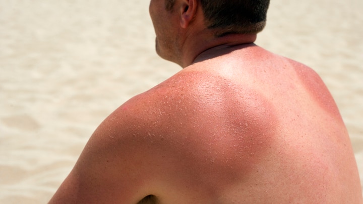 man with sunburned shoulders sitting on a beach
