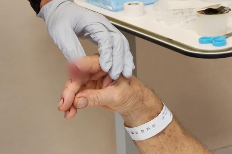 A man's arm, with a hospital bracelet around the wrist, held up to display a severed finger, which is blurred out.