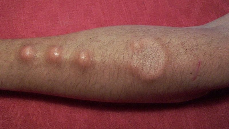 A man's arm showing off his sub-dermal implants