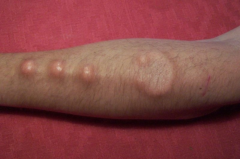 A man's arm showing off his sub-dermal implants