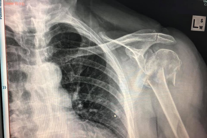 An x-ray showing a broken shoulder.