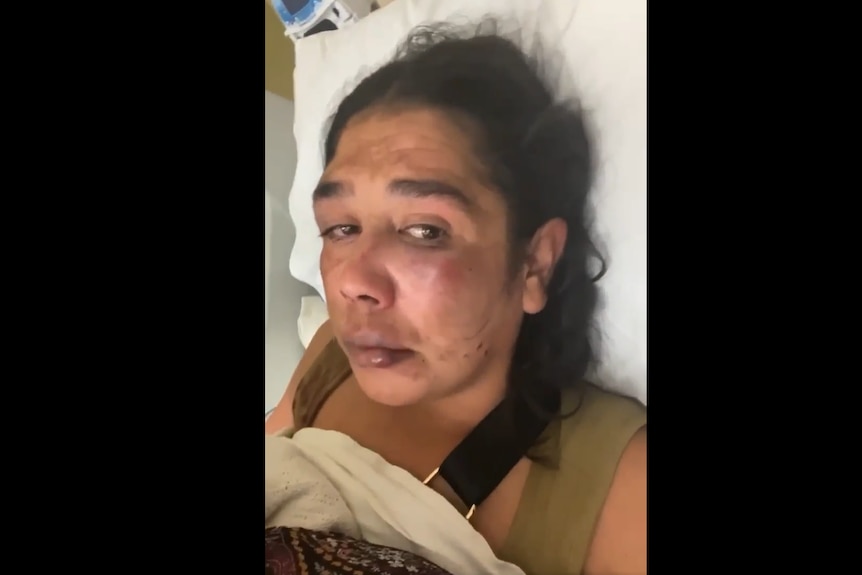 A woman with black hair in a hospital bed with swollen bruises on her face.
