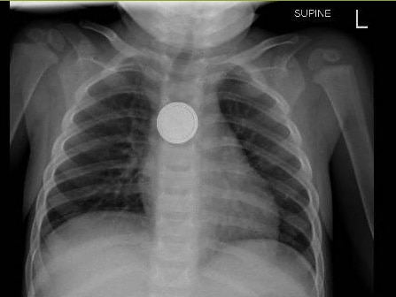 An x-ray of a baby who swallowed a button battery.