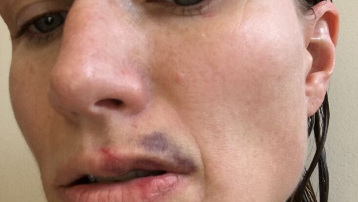 Kim Proudlove's face injuries