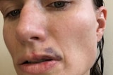 Kim Proudlove's face injuries