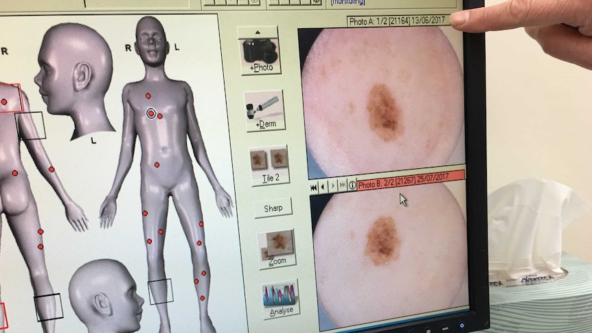 A doctor points at a computer screen showing images of a melanoma taken six weeks apart.