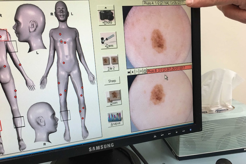 A doctor points at a computer screen showing images of a melanoma.