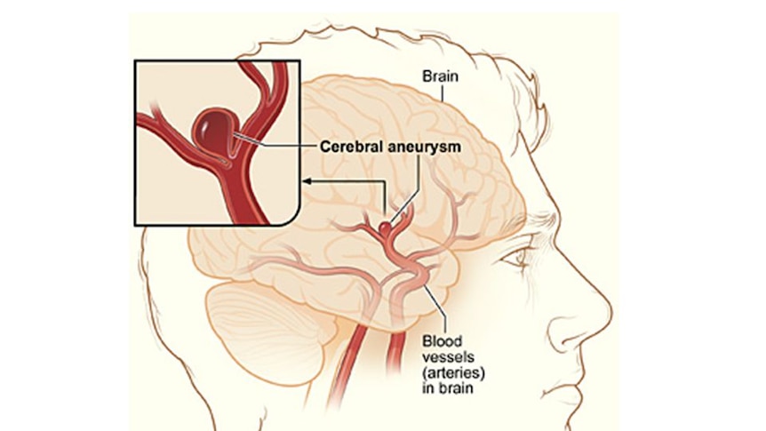 A diagram of a blood vessel in the brain showing a sac of blood that looks like a berry.