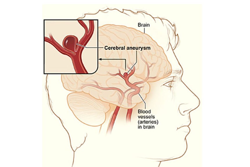 A diagram of a blood vessel in the brain showing a sac of blood that looks like a berry.