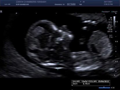 Born with organs outside her body, Elsie is set to celebrate her first ...