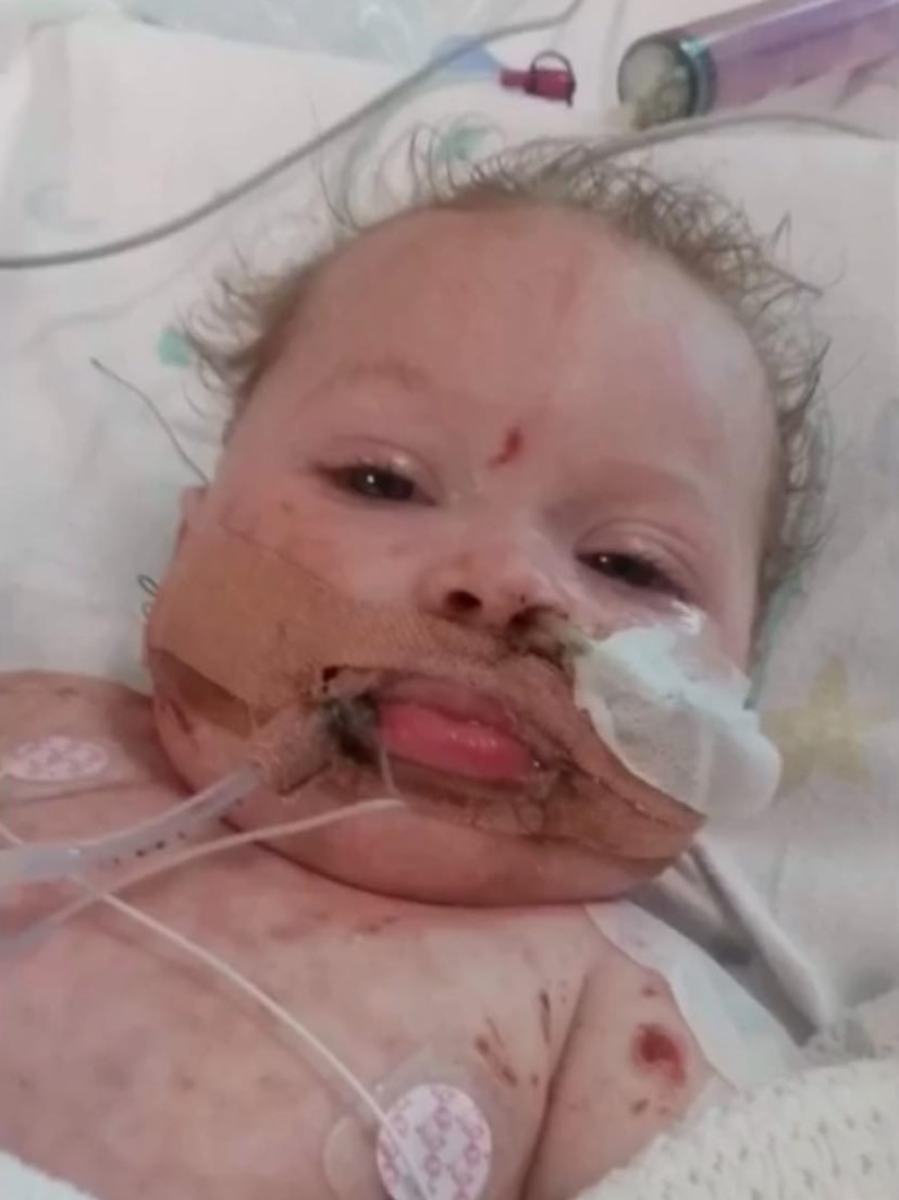 A baby has tubes in her mouth and nose, she is covered in a rash from meningococcal and lies on a white hospital bed.