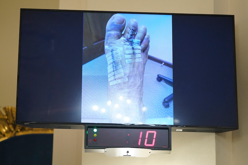 A photo of Capitol Police officer Gonell's foot injury sustained during the riot.