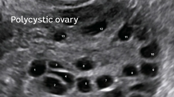 Typical appearance of a polycystic ovary shows a string of black dots on an ultrasound