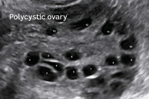 Whereas this ultrasound of a polycystic ovary shows many small follicles grouped mostly around its periphery.