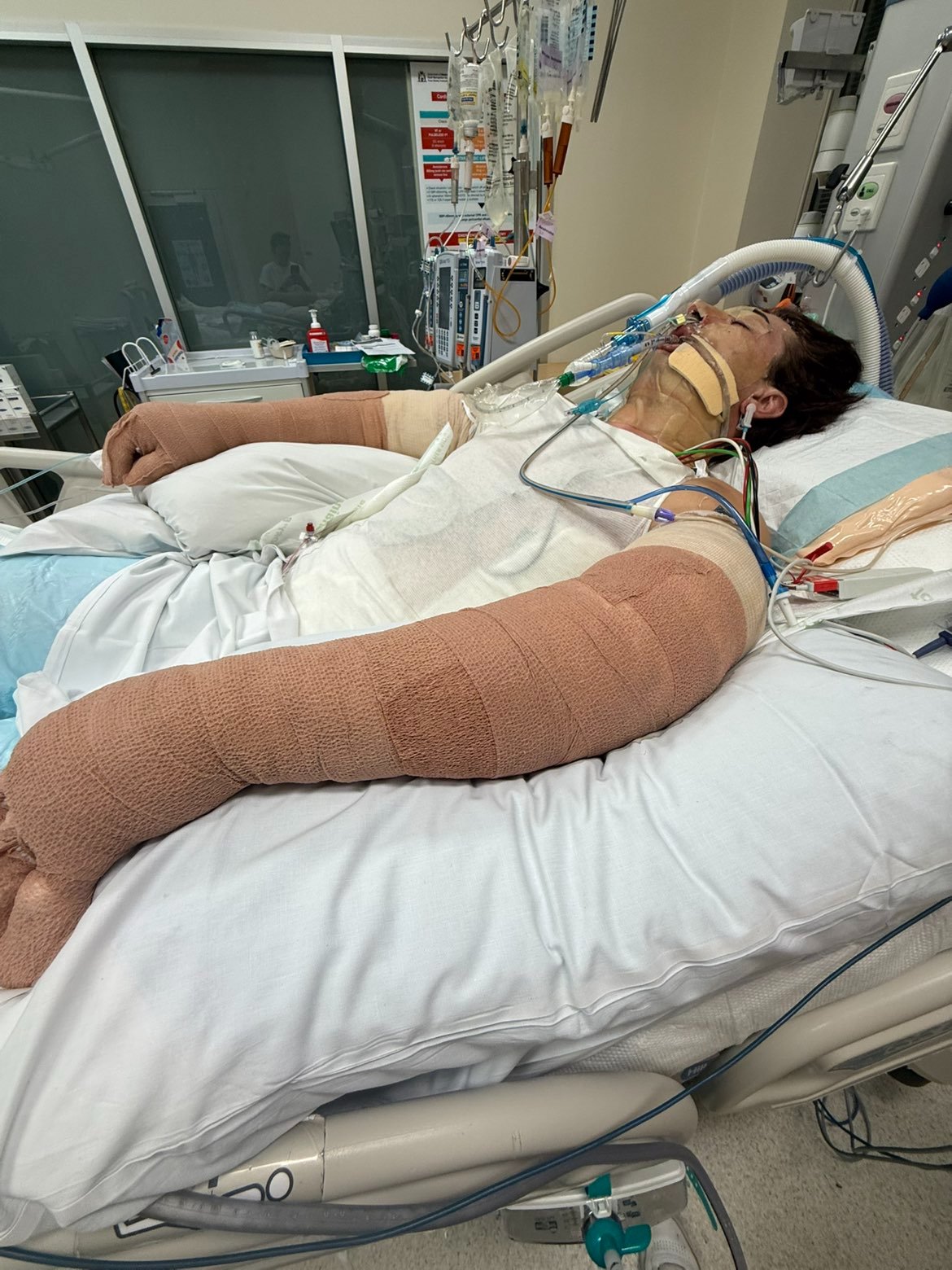 Un hombre gravemente enfermo duerme en el hospital con tubos respiratorios