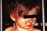 A child, a black box across his eyes to protect his identity, is covered in an angry red rash.