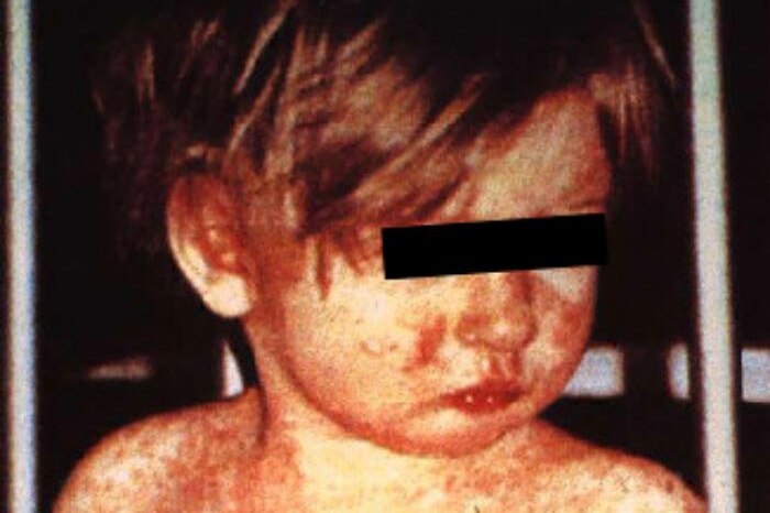 A child, a black box across his eyes to protect his identity, is covered in an angry red rash.
