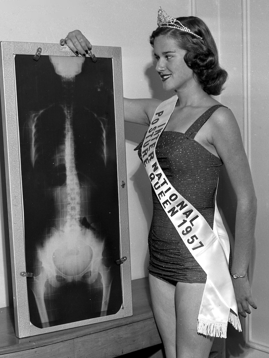 A woman wearing a tiara and a sash holds an X-ray of her spine
